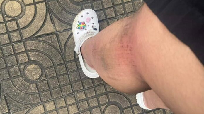 ขาเจ็บ