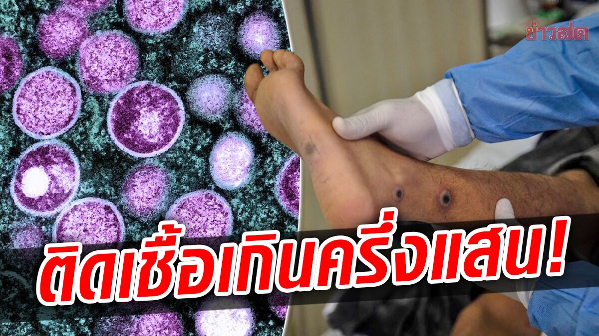 อียิปต์พบฝีดาษลิง “คนแรก” ทั่วโลกติดเชื้อเกินครึ่งแสน-สหรัฐสูงสุดทะลุ 2 หมื่นคน