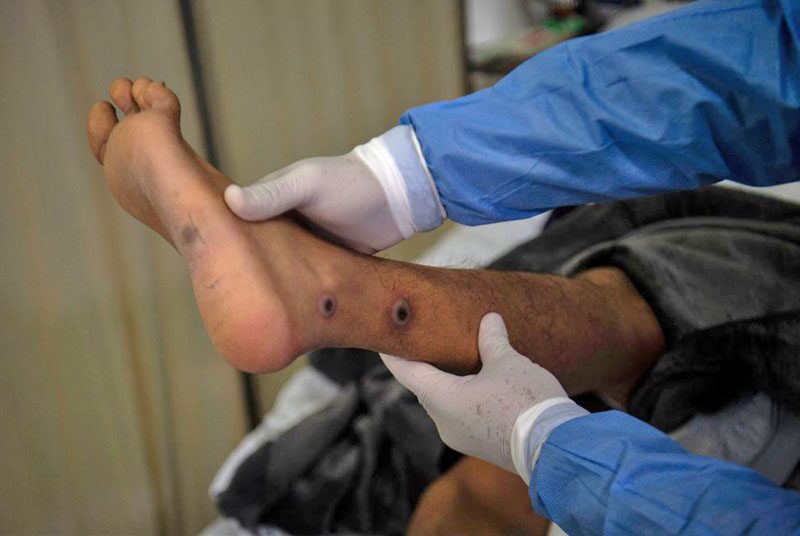 Egypt finds 'first' monkey pox