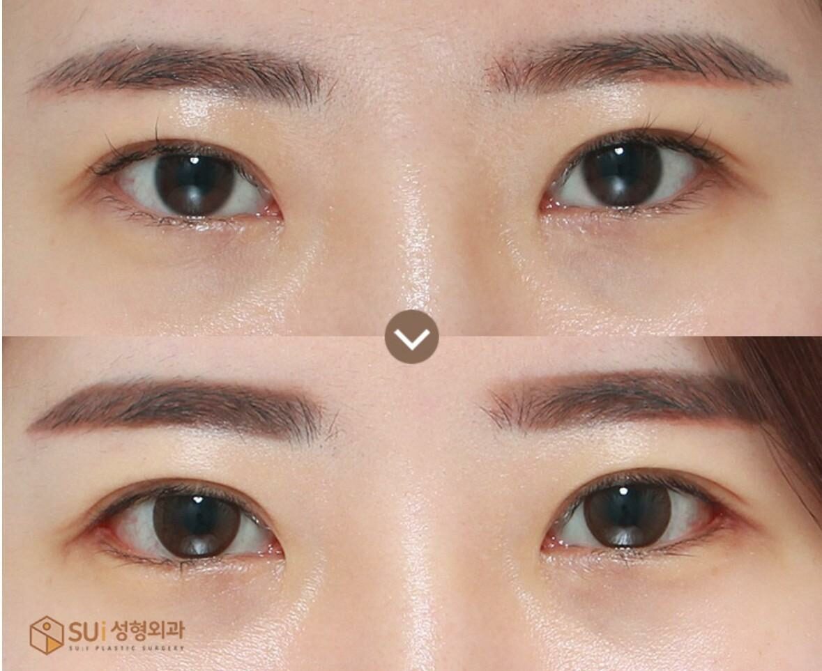เทคนิคทำตาสองชั้นแบบเกาหลี มีกี่แบบ เลือกอย่างไรให้เหมาะสม - ข่าวสด เทคนิคทำตาสองชั้นแบบเกาหลี มีกี่แบบ เลือกอย่างไรให้เหมาะสม - ข่าวสด