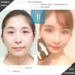 ข้อควรรู้ก่อนศัลยกรรมปรับโครงหน้าที่เกาหลี แก้โหนกแก้ม เสริมคาง อยากหน้าเรียวได้รูปต้องอ่าน