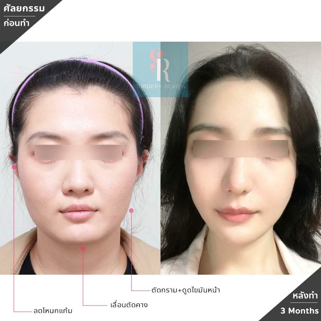 ผ่าตัดกราม