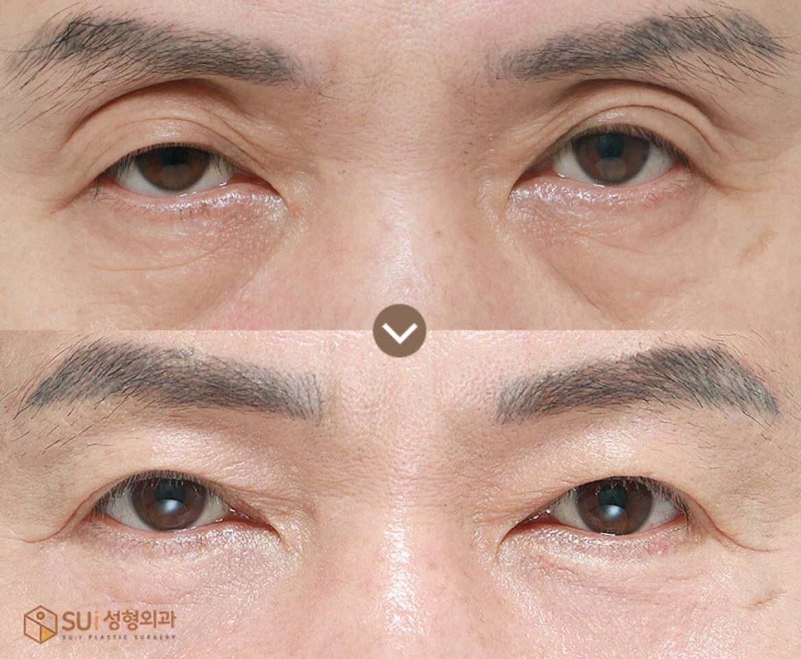 เทคนิคทำตาสองชั้นแบบเกาหลี มีกี่แบบ เลือกอย่างไรให้เหมาะสม - ข่าวสด เทคนิคทำตาสองชั้นแบบเกาหลี มีกี่แบบ เลือกอย่างไรให้เหมาะสม - ข่าวสด