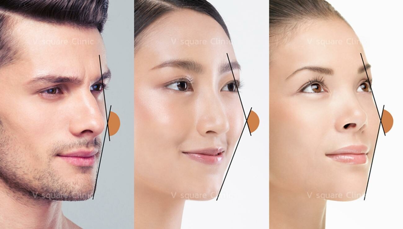 การฉีดฟิลเลอร์แก้มส้มทำให้ใบหน้าดูมีมิติมากขึ้น