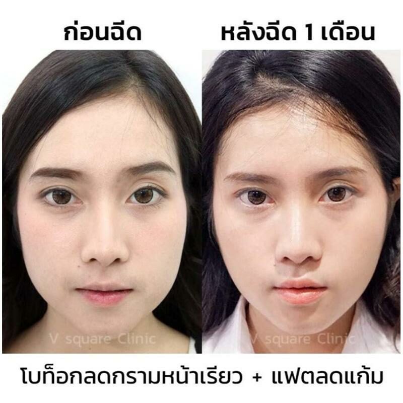 รีวิวเมโสแฟต