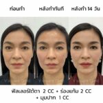 ฉีดฟิลเลอร์ที่ไหนดี ? เช็กลิสต์เลือกคลินิกฉีดฟิลเลอร์ในกรุงเทพที่ดีที่สุด 