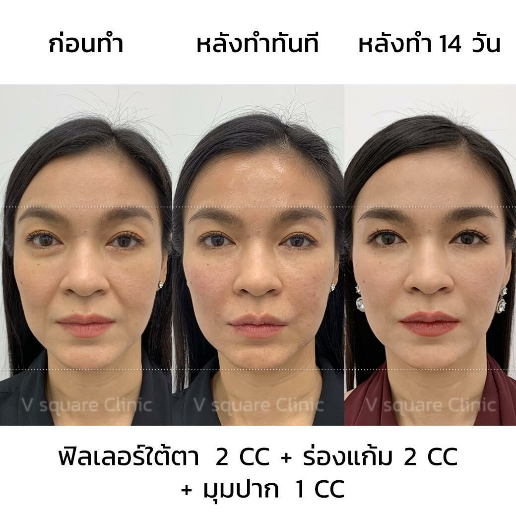 รีวิวฉีดฟิลเลอร์ที่ไหนดี
