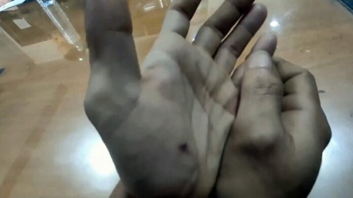 บาดมือ