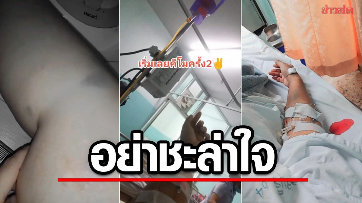 สาวแชร์ประสบการณ์! อย่าชะล่าใจ รอยจ้ำเขียว สุดท้ายกลายเป็นมะเร็งเม็ดเลือดขาว