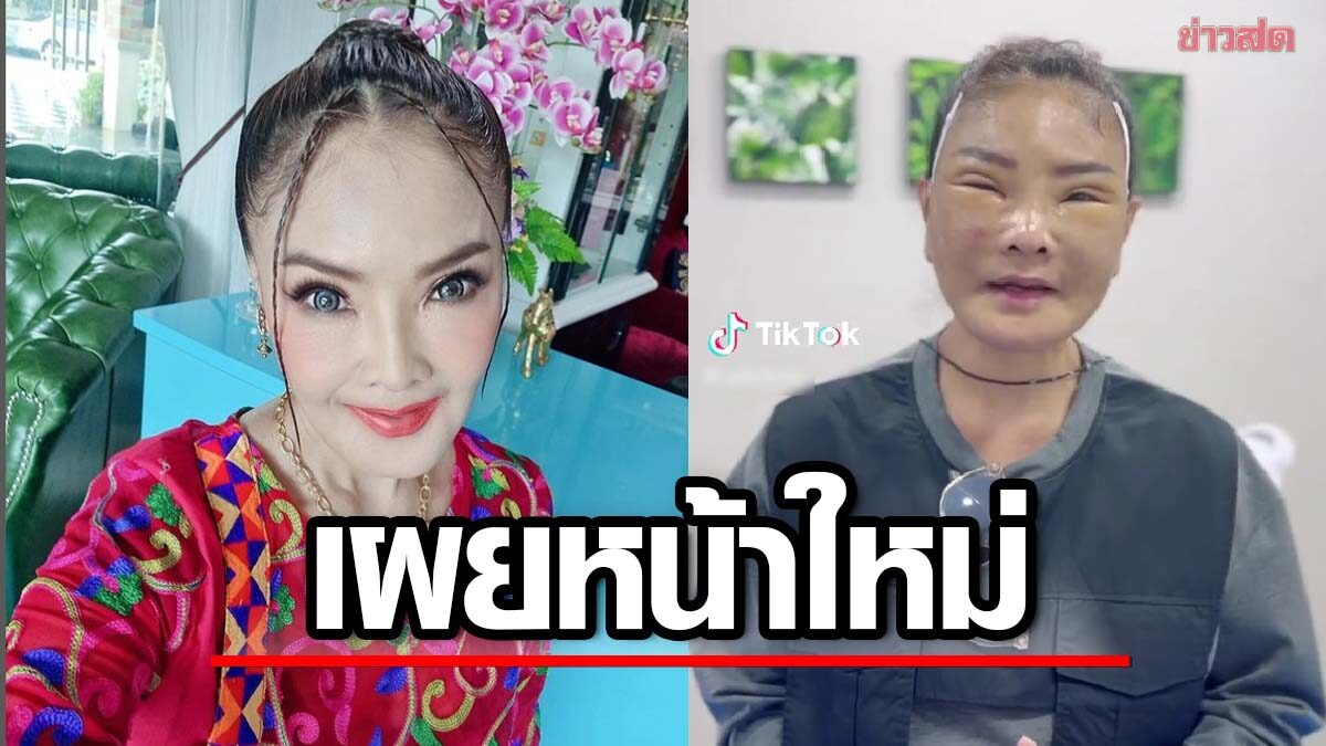 ยอดวิวเกือบล้าน ดาว มยุรี เปิดหน้าสด หลังผ่าตัด แห่ให้กำลังใจ
