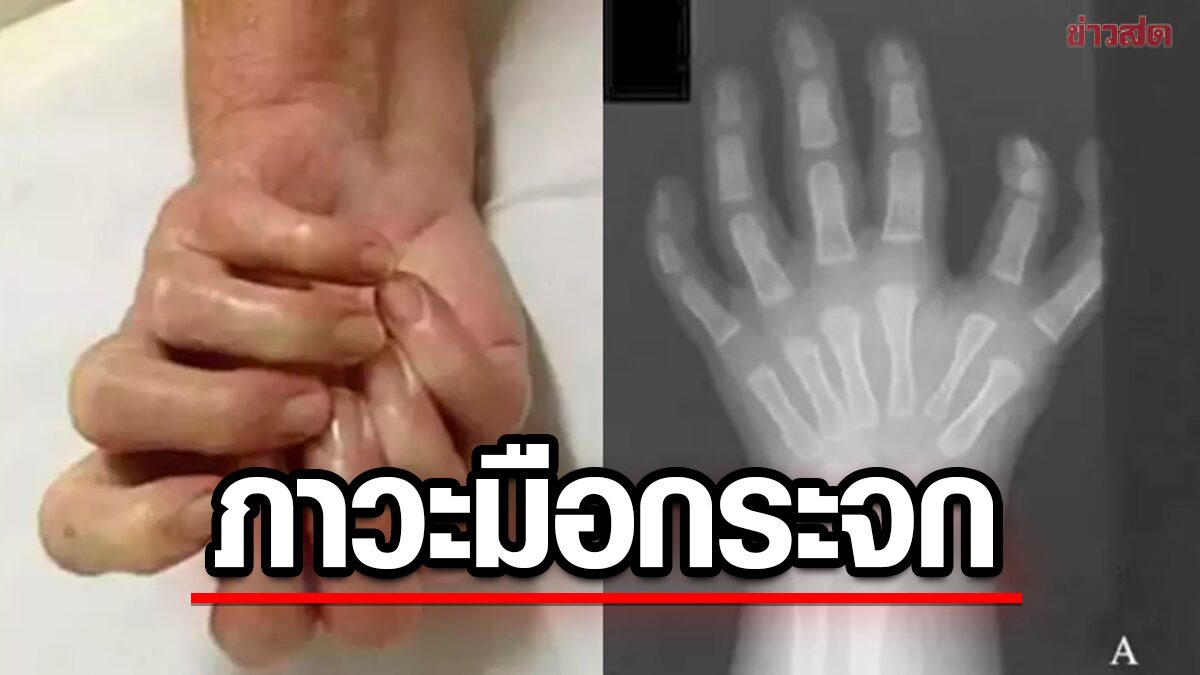 Open rare condition! 'Hand mirror' has many fingers for unknown reasons