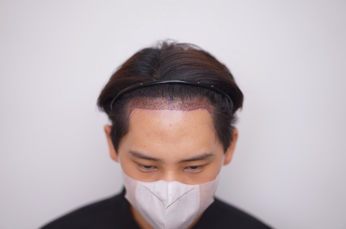 การปลูกผมคืออะไร
