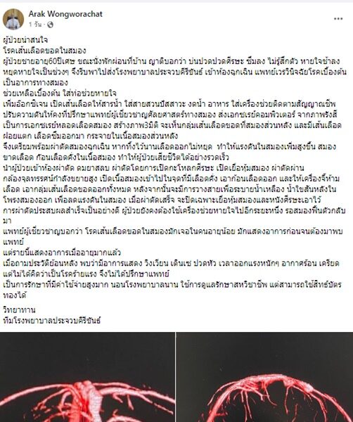 หมอเตือน 'ปวดหัว' อาจร้ายแรงกว่าที่คิด ระวังป่วย 'โรคเส้นเลือดขอดในสมอง' - หมอเตือน 'ปวดหัว' อาจร้ายแรงกว่าที่คิด ระวังป่วย 'โรคเส้นเลือดขอดในสมอง' -