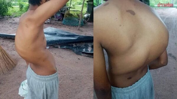 ผวจ.ฉะเชิงเทรา รุดช่วย น้องไนท์ วัย 15 ปี ป่วยหลังคด กดปอด แม่ เผยสุดดีใจ ขอบคุณที่ให้การช่วยเหลือ