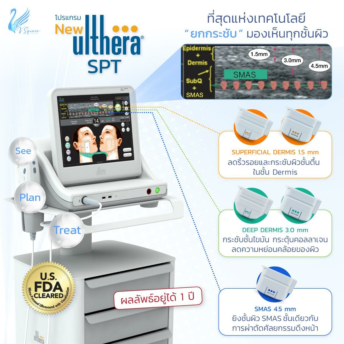 ulthera คืออะไร 