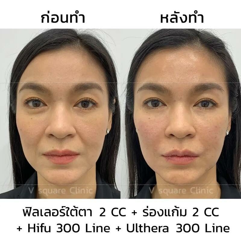 รีวิวหลังทำ Ulthera 