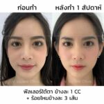 ฟิลเลอร์ใต้ตา ลดริ้วรอย ถุงใต้ตา ขอบตาดำ กี่วันเห็นผล มีอะไรบ้างที่ควรรู้ ?
