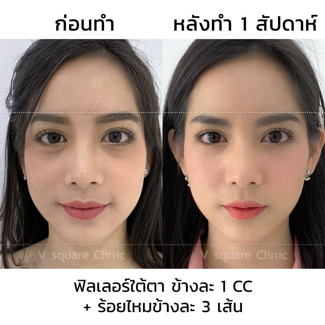 รีวิว ฉีดฟิลเลอร์ใต้ตา 1CC รีวิว ฉีดฟิลเลอร์ใต้ตา 1CC