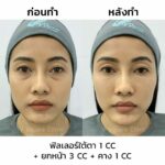 ฟิลเลอร์ใต้ตา ลดริ้วรอย ถุงใต้ตา ขอบตาดำ กี่วันเห็นผล มีอะไรบ้างที่ควรรู้ ?