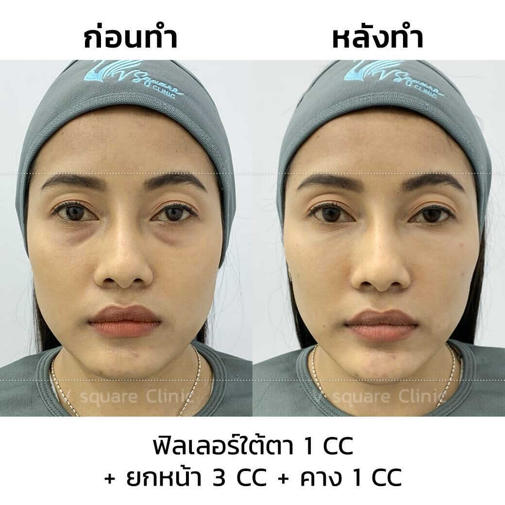 รีวิว ฉีดฟิลเลอร์ใต้ตา 1CC รีวิว ฉีดฟิลเลอร์ใต้ตา 1CC