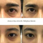 ฉีดฟิลเลอร์ใต้ตา ที่ไหนดี ? แก้ไขตรงจุด ผลลัพธ์ดี ปลอดภัย ไม่เสี่ยงเป็นก้อน