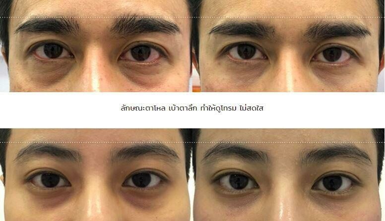 ฟิลเลอร์ใต้ตาช่วยแก้ร่องน้ำตาเบ้าตาลึก
