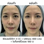 ฟิลเลอร์ใต้ตา ลดริ้วรอย ถุงใต้ตา ขอบตาดำ กี่วันเห็นผล มีอะไรบ้างที่ควรรู้ ?