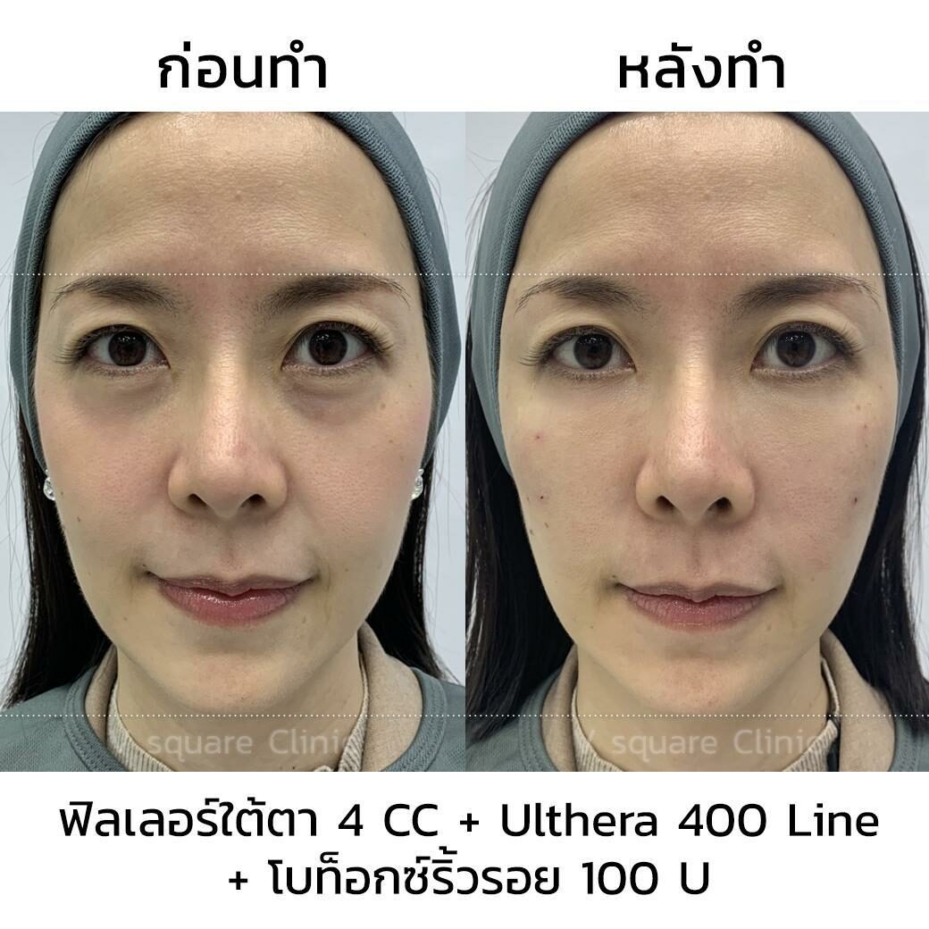 รีวิว ฉีดฟิลเลอร์ใต้ตา 4CC รีวิว ฉีดฟิลเลอร์ใต้ตา 4CC