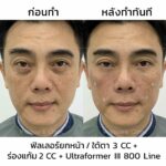 Ulthera ราคาเท่าไหร่ ? ราคาถูก ราคาแพง ต่างกันอย่างไร ?