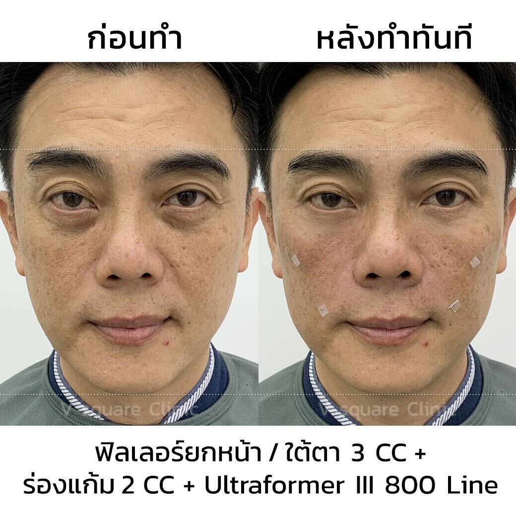 รีวิวหลังทำ Ulthera 