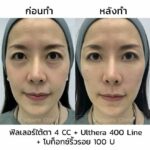 Ulthera คืออะไร ? ช่วยยกกระชับผิวได้อย่างไร ? ข้อดี ข้อเสีย ราคา 