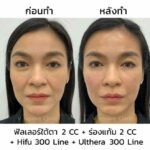 Ulthera คืออะไร ? ช่วยยกกระชับผิวได้อย่างไร ? ข้อดี ข้อเสีย ราคา 