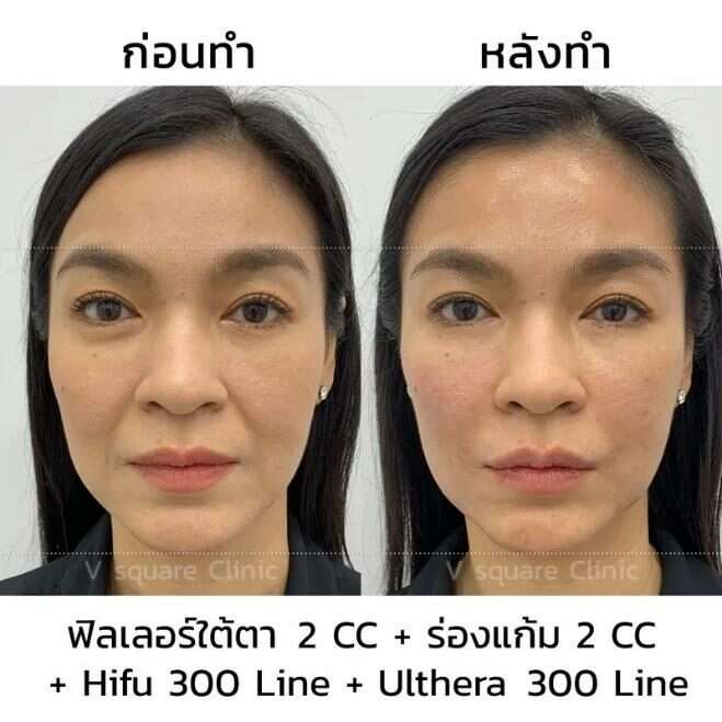 รีวิว ulthera รีวิว ulthera