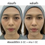 ฟิลเลอร์ใต้ตา ลดริ้วรอย ถุงใต้ตา ขอบตาดำ กี่วันเห็นผล มีอะไรบ้างที่ควรรู้ ?
