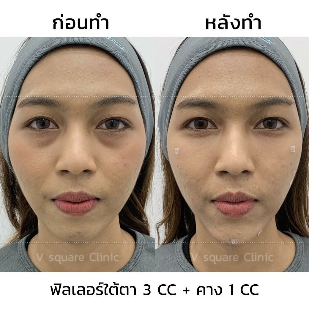 รีวิว ฉีดฟิลเลอร์ใต้ตา 3CC รีวิว ฉีดฟิลเลอร์ใต้ตา 3CC