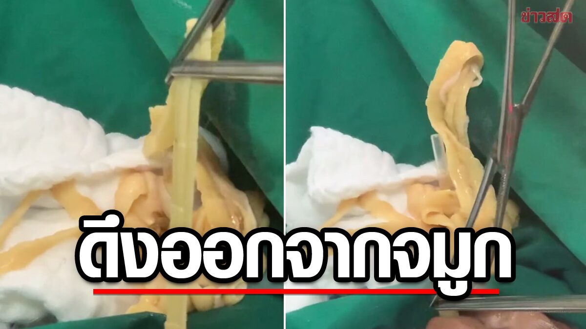 So scary! An example of people who like Soi Ju. meter long tapeworm The