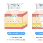 Ultraformer iii นวัตกรรมยกกระชับ ปรับรูปหน้า แบบไม่ต้องผ่าตัด 