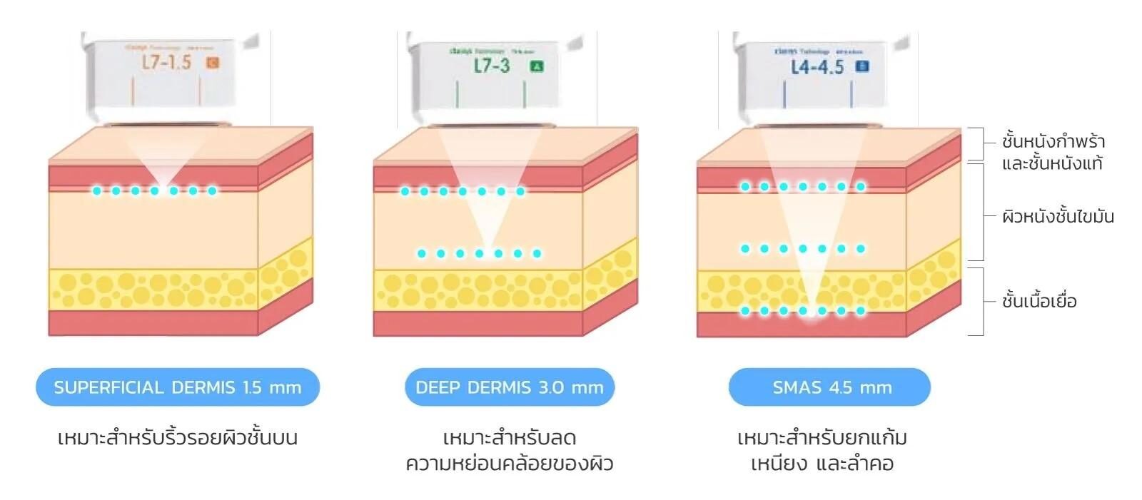 หัวยิงความลึก Ultraformer III หัวยิงความลึก Ultraformer III