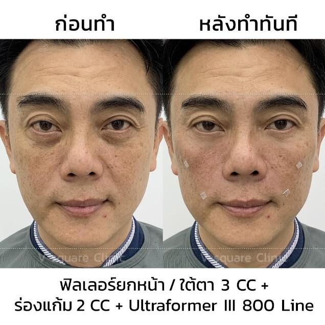 รีวิว Ulthera