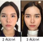 Ultraformer iii นวัตกรรมยกกระชับ ปรับรูปหน้า แบบไม่ต้องผ่าตัด 