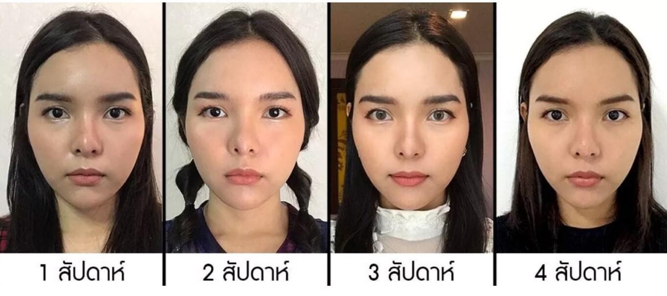 รีวิวUltraformer III รีวิวUltraformer III