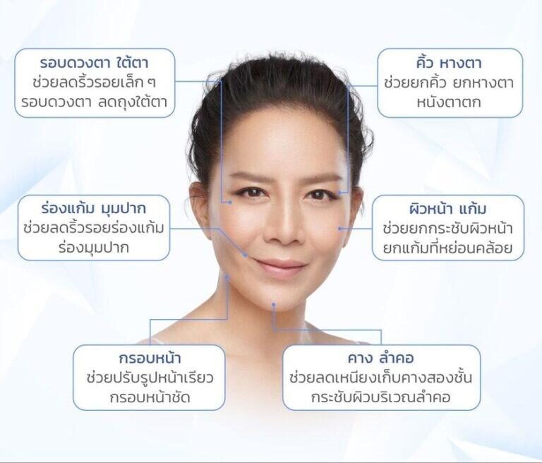 ทำ Ulthera ตำแหน่งไหนได้บ้าง