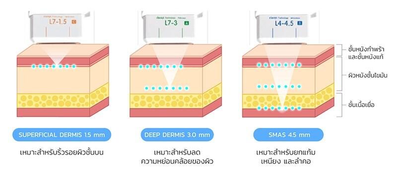 หัวยิง Ulthera SPT หัวยิง Ulthera SPT