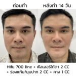 Ultraformer iii นวัตกรรมยกกระชับ ปรับรูปหน้า แบบไม่ต้องผ่าตัด 