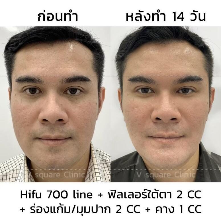 รีวิวUltraformer III รีวิวUltraformer III