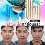 หนังตาตก ตาสองชั้นหลบในเกิดจากอะไร? จะแก้ปัญหาอย่างไรดี