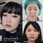 หนังตาตก ตาสองชั้นหลบในเกิดจากอะไร? จะแก้ปัญหาอย่างไรดี