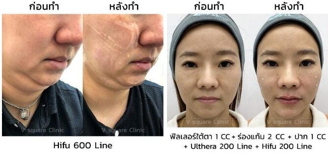 hifu รีวิว