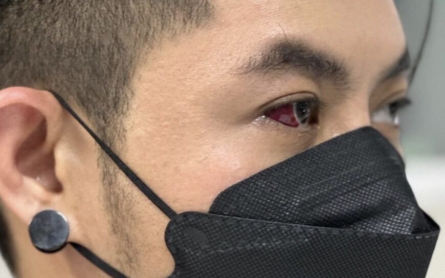 เก่ง ธชย เยื่อบุตาขาวอักเสบ