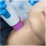 Thermage ช่วยเรื่องอะไรบ้าง ? เห็นผลเร็วไหน เหมาะกับใคร ? อยู่ได้นานไหม ?